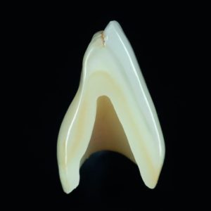 Couronne Ceramo-Céramique Zircone