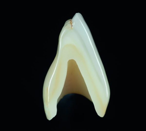 Couronne Ceramo-Céramique Zircone